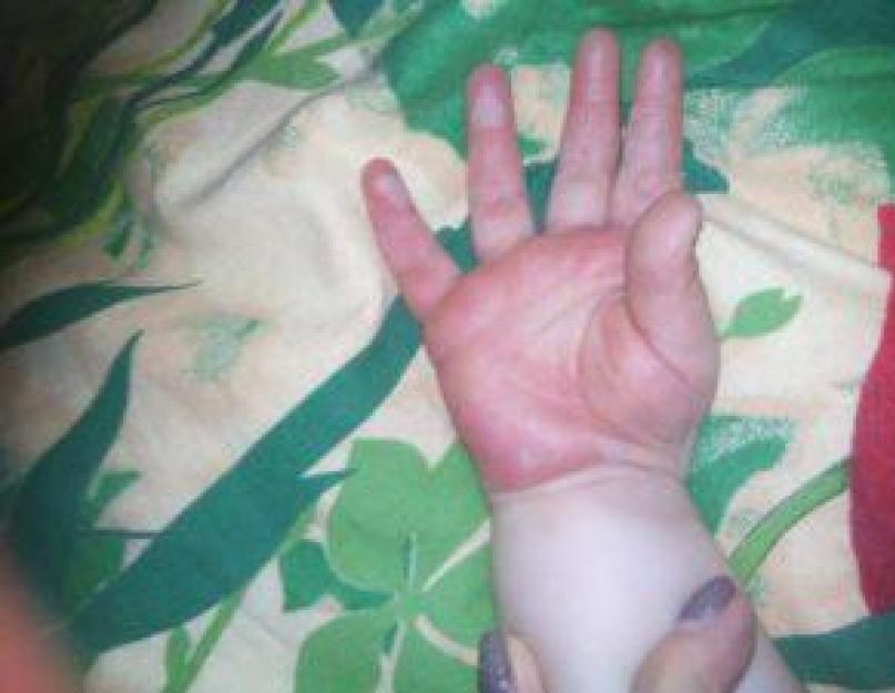Слезает кожа с рук у ребенка причины. Почему у ребёнка может облазить кожа на пальцах рук и что с этим делать