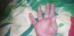Почему у ребёнка может облазить кожа на пальцах рук и что с этим делать